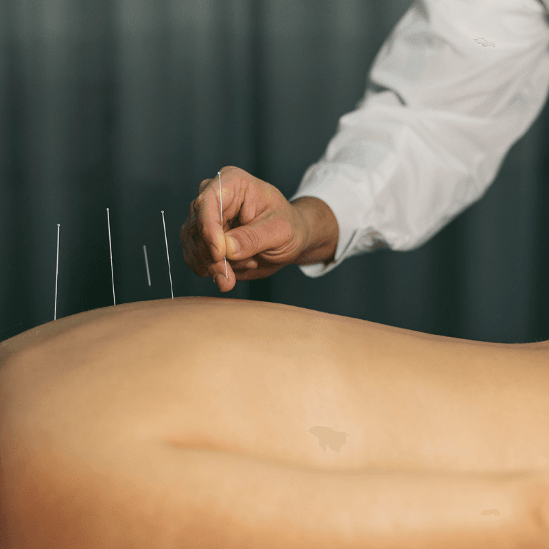 Acupuncture